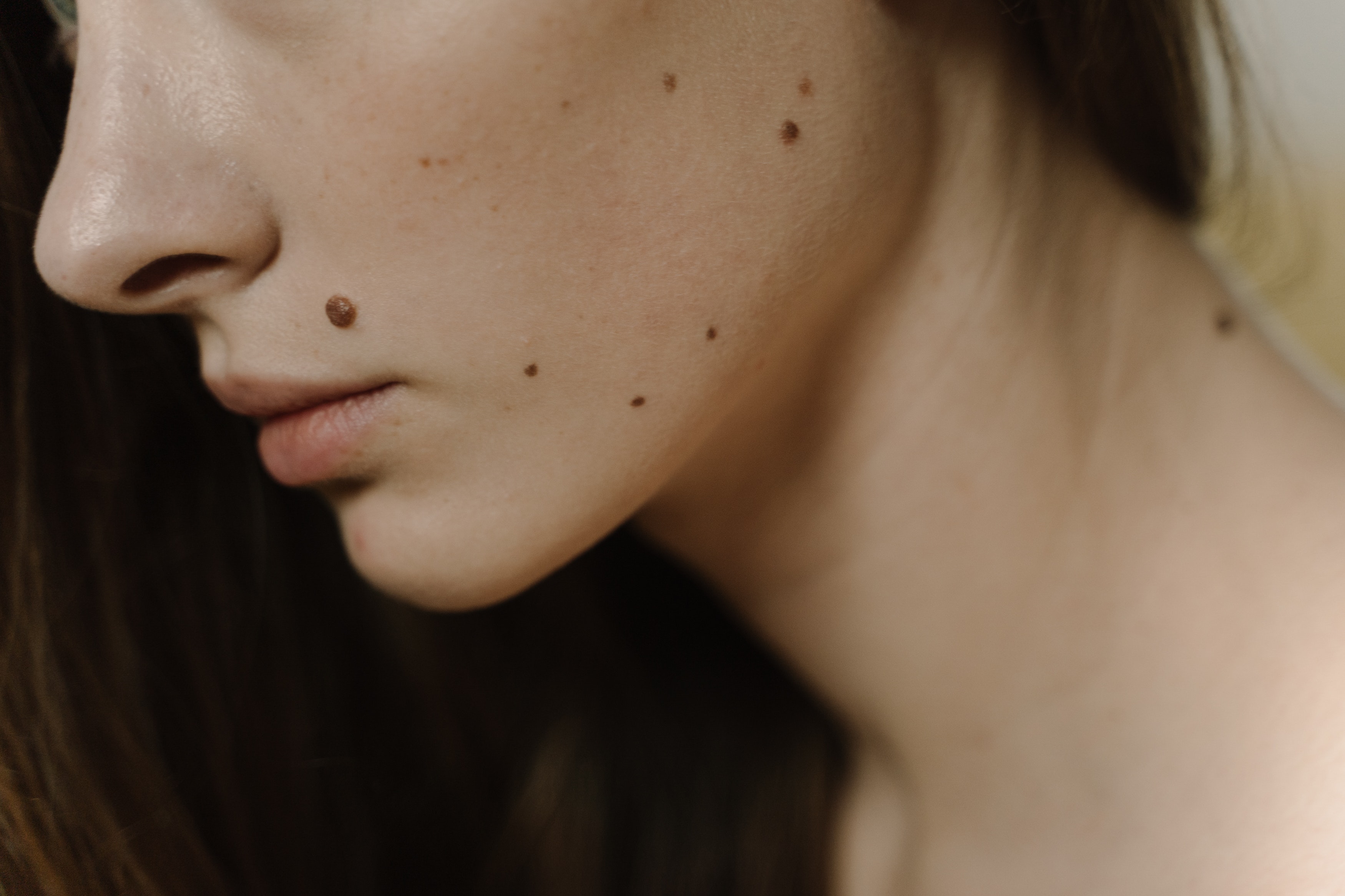 Раннее выявление и профилактика меланомы кожи