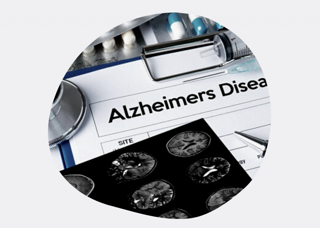 Постановка диагноза Альцгеймера