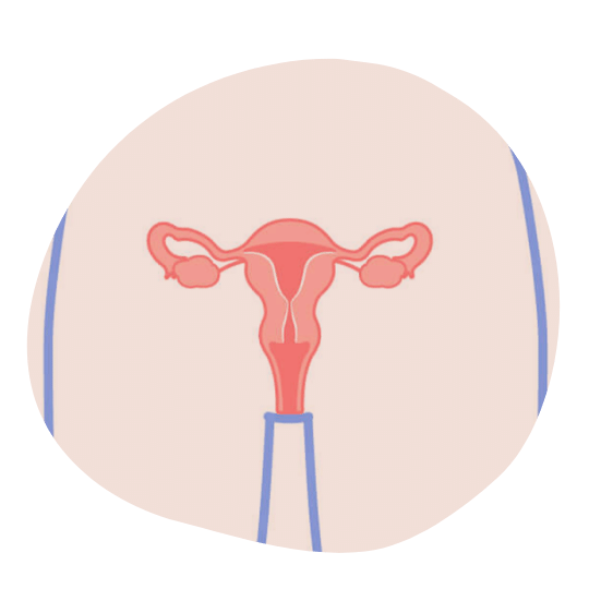 Что вы знаете о раке эндометрия (тела матки).png