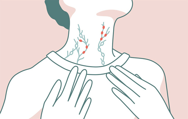 «Безболезненное увеличение лимфоузла — частый симптом»: что нужно знать о лимфомах